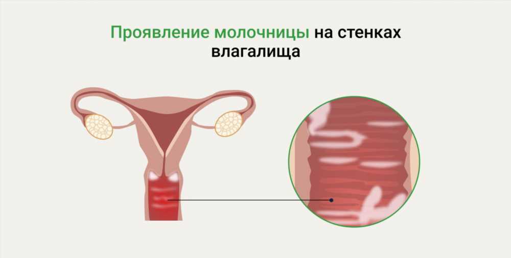 Белые выделения у женщин: причины, симптомы и методы лечения