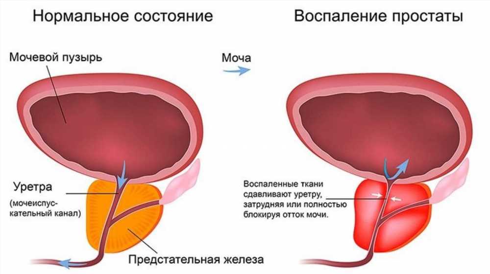 Как победить простатит: эффективные методы лечения и профилактика