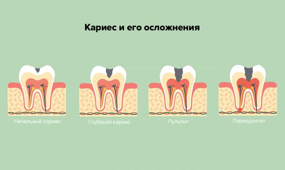 Мышьяк в зубе: Механизм действия и последствия