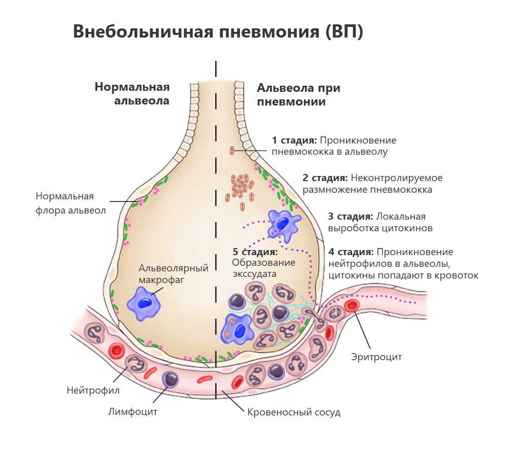 Пневмония у детей: Последствия и важные аспекты восстановления