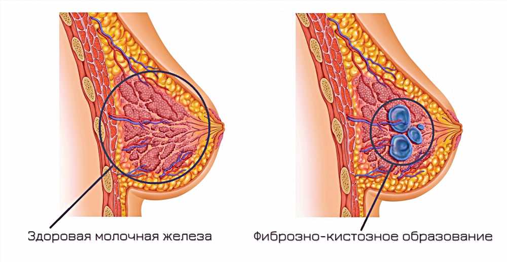 Почему болезненная грудь: Причины и Советы по Улучшению Здоровья