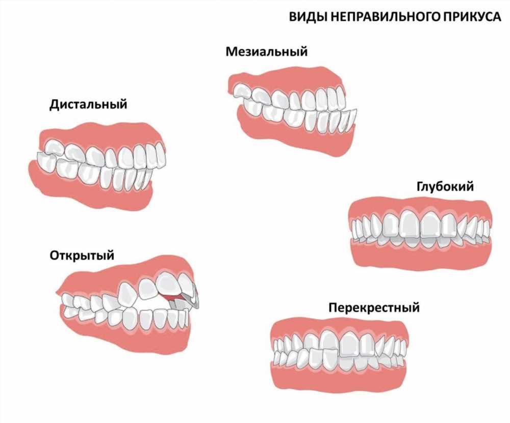 Последствия неправильного прикуса: Опасности, Проблемы и Пути Решения