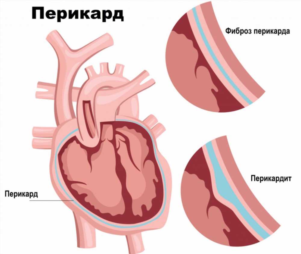 Тампонада сердца: причины и факторы риска