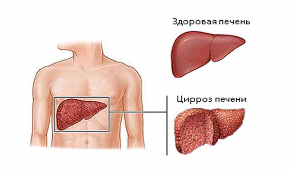 Влияние цирроза на печень: что происходит с органом при развитии болезни